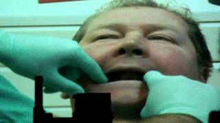 3e séance clinique, prise d'occlusion, prothèse amovible