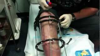 self removal of ilizarov frame