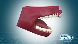 Виниры для зубов Perfect Smile Veneers