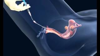 Dra. Martha García - Inseminación intrauterina, en qué consiste