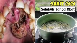 TANPA RESEP DOKTER... SAKIT GIGI SEMBUH SEKETIKA || RAMUAN SAKIT GIGI PALING AMPUH 