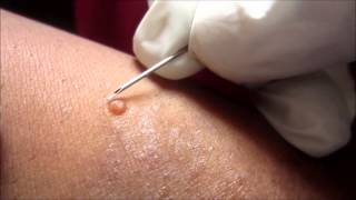 Removing H P Body From Molluscum Contagiosum