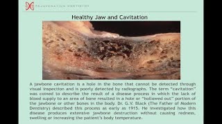 Dental Problems Can Cause Chronic, Systemic Disease! Modern solutions, Cavitations, Mercury.