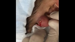 Crazy! We Open & Drain Giant Pus-Filled Earlobe, You Won't Believe!