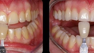 Blanqueamiento dental casero como blanquear los dientes en casa