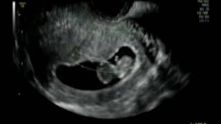 Ecografia da Carol - Embrião de 10 semanas