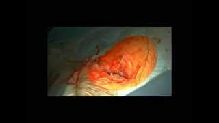 Implantacja CRT-P - dr Marcin Gułaj, Białystok (CRT implantation)