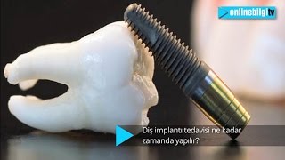 Diş implantı tedavisi süresi ne kadardır?