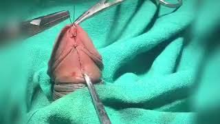 Frenuloplasty by Dr Raj Kumar Sharma, Urologist, Ranchi