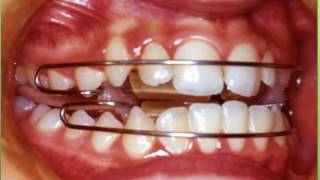klammt Activator 1 : Orthodontist