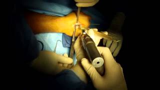 Treatment of Broken Finger Fracture Injury Hand Surgery by Katy TX Hand Surgeon Dr Jeffrey E Budoff