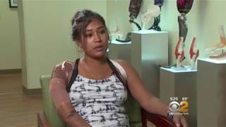 Woman Dismembered By Boyfriend In Guyana Receives New Arms, Hands « CBS New York