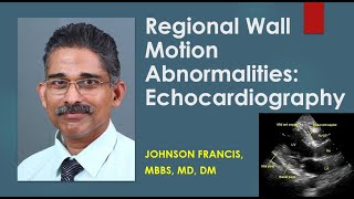 Regional wall motion abnormalities: Echocardiography