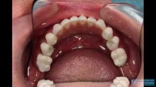 Cigomáticos Implantes Zigomáticos - Implantes Cigomáticos - zigomatico - Dr. Ismael Soriano