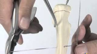 tension band wiring