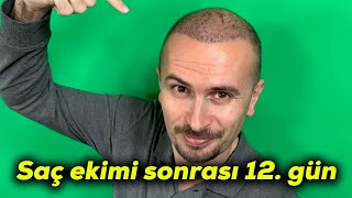 Saç ekimi sonrası 12. gün | Ekilenler uzuyor