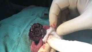 BASAL CELL CARCINOMA PINNA WITH MAGGOTS- LASER EXCISION
