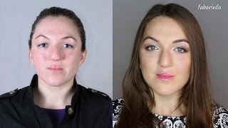 ДЕФЕКТ "заячья" ГУБА. До и После КОНТУРНОЙ пластики