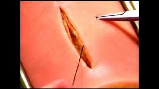 How to perform a Running Subcuticular Closure: Common Errors