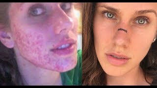 HOW I CLEARED MY ACNE ( Chronic, Cystic, Digestive, Hormonal)