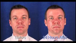 MicroLaser Peel Treatment at Renaissance Plastic Surgery