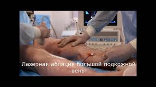 Лазерная абляция большой подкожной вены