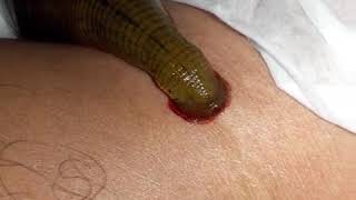 Leeches therapy indonesia by.tumtherapy