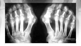 valgus pro отзывы

  - рекомендую лечение hallux valgus косточки