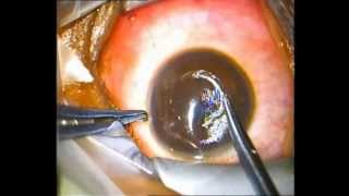 Dr. Riad Fikry - Simultaneous Corneal Ring Segment Insertion and Corneal Cross-linking Technique