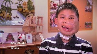 Maladies orphelines : sa malformation veineuse lui a déformé le visage.