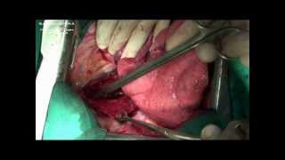 Transthoracic Subtotal Esophagectomy ( Lewis type procedure)
