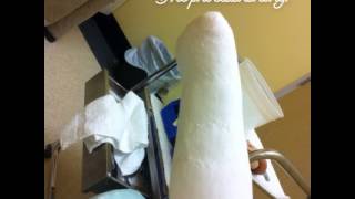 Amputee Prosthetics