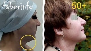 Подтяжка БРЫЛЕЙ нитями / БЕЗ ОПЕРАЦИИ / До и После