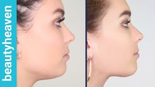 We try: Jawline Slimming With Botox Injections