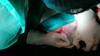 عملية قيصرية Cesarean