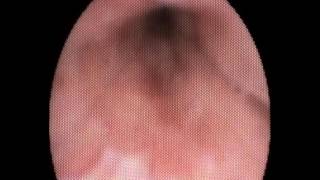 sleep endoscopy, jahan