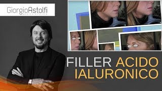 Filler Acido Ialuronico Prima e Dopo