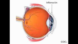 Tipos Uveitis coc.