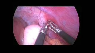FB stomach needle