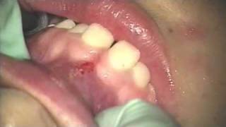 LABIAL FRENECTOMY
