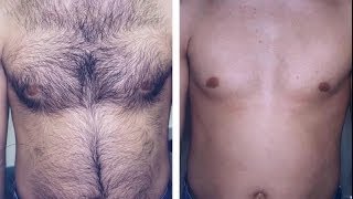 Kişilər Üçün Lazer Epilyasiyası .Лазерная эпиляция для мужчин в баку Tel: (012)498 80 85 DERMALIFE