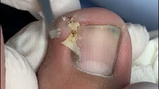 Trimming for the dirty nails