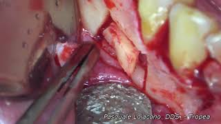 Odontogenic cyst - ENG Version
