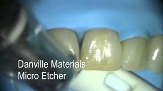 treat Black Triangles with Bioclear bonding