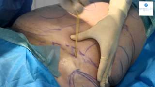 Liposuction (Live): Step by Step | London Lipo Institute