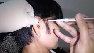 Chunks of Earwax Removed From Woman's Ear Using Lighted Ear Curette