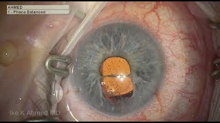 Iris Repair after Complicated Cataract Surgery