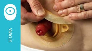 Urostomia: rimozione dispositivo due pezzi click Coloplast