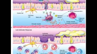 Pulmonary Disease