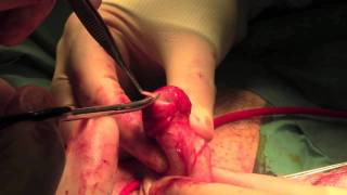 Total glans resurfacing for premalignant and malignant penile lesions